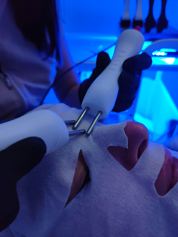 elimina arrugas estimulando tus componentes biológicos con el biolifting en nuestra clínica estética en andujar